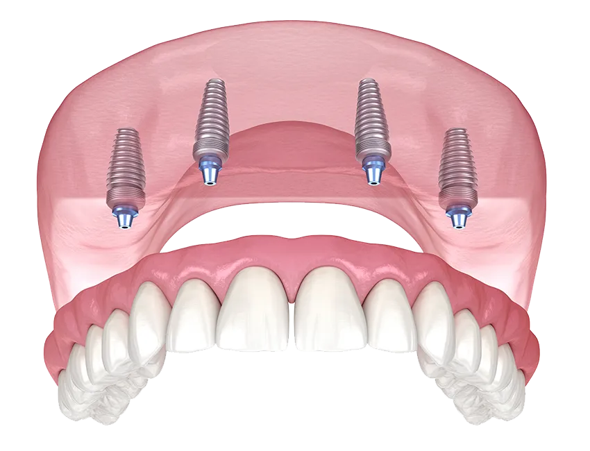 A full arch of fixed teeth carried on four implants