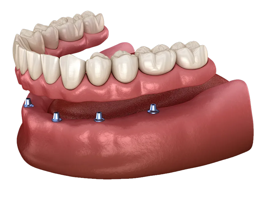 A denture clipping onto dental implants