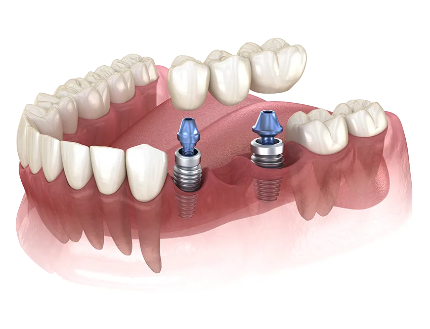 A fixed bridge supported by two dental implants