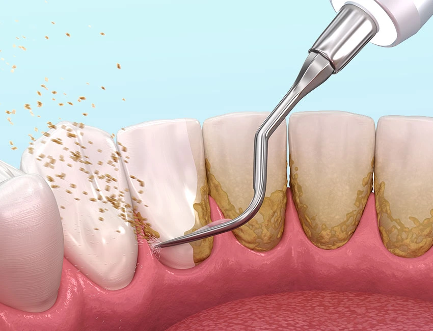 Periodontal Care at Wildomar Smiles Dentistry