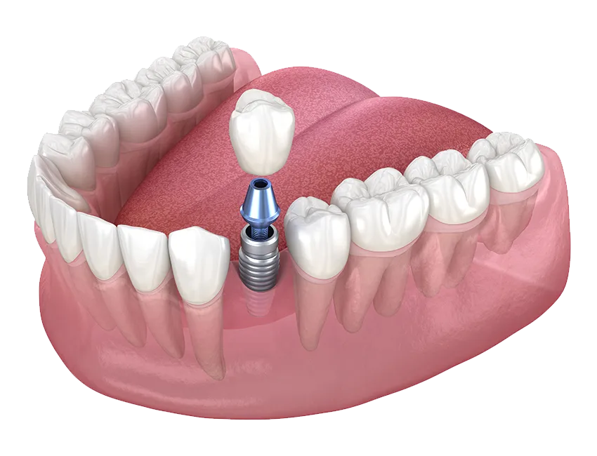 A single implant replacing one missing tooth