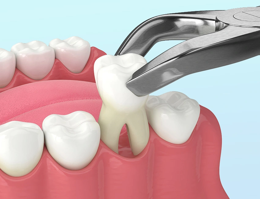 Tooth Extraction at Wildomar Smiles Dentistry