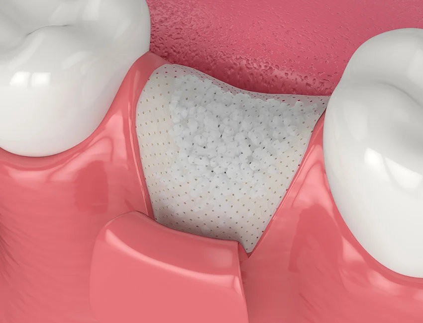 What Happens If I Don't Get a Bone Graft After Extraction? — Wildomar Smiles Dentistry