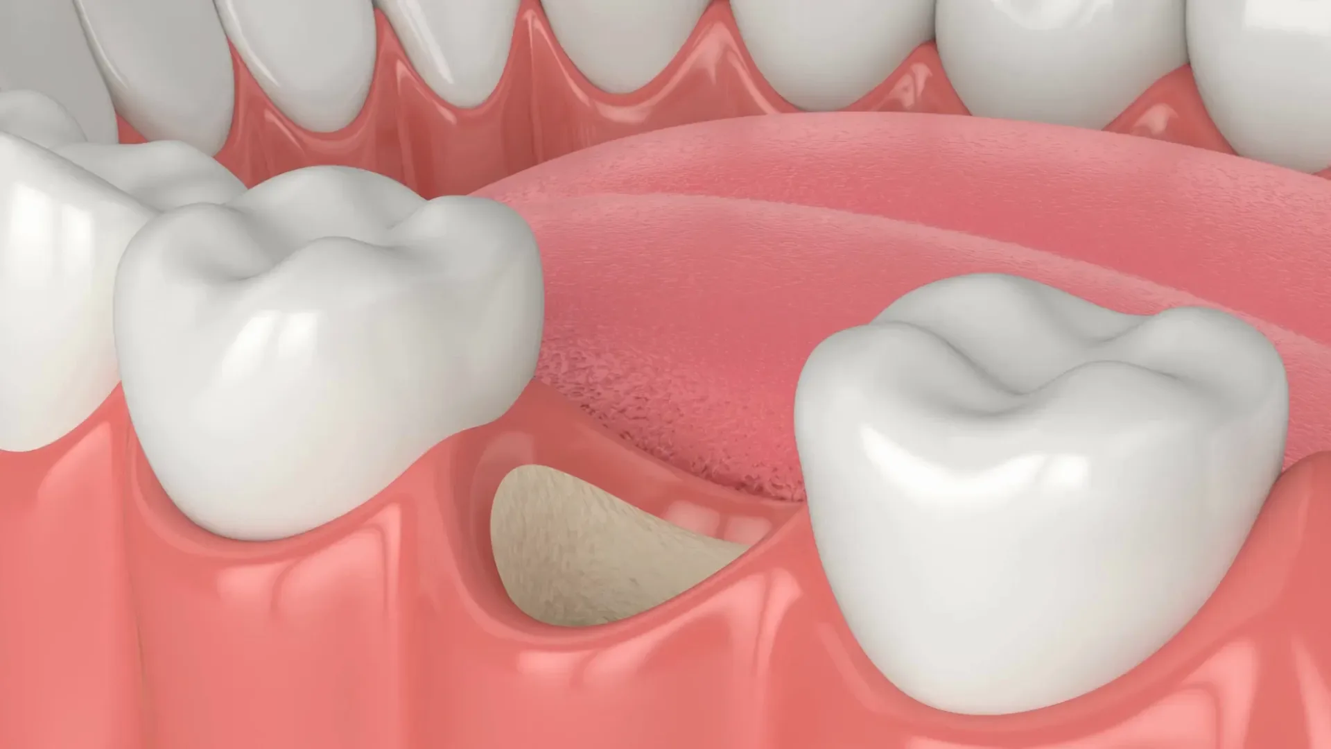 Dental Bone Grafting at Wildomar Smiles Dentistry