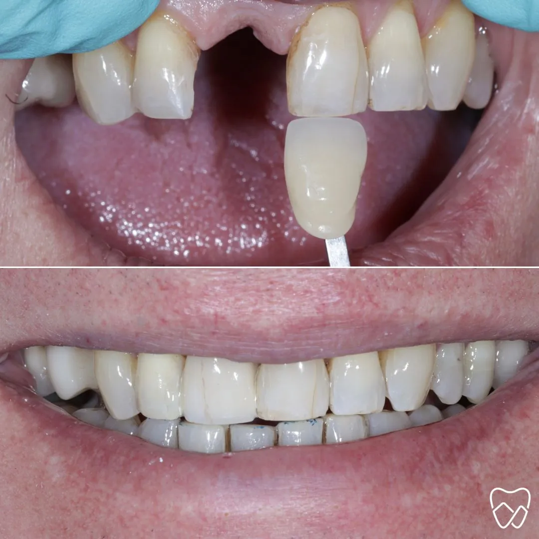 Dental Bridges at Wildomar Smiles Dentistry