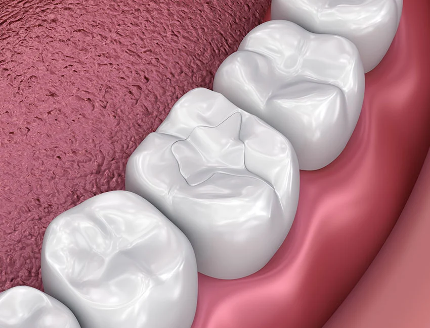 Dental Fillings at Wildomar Smiles Dentistry in Wildomar, CA