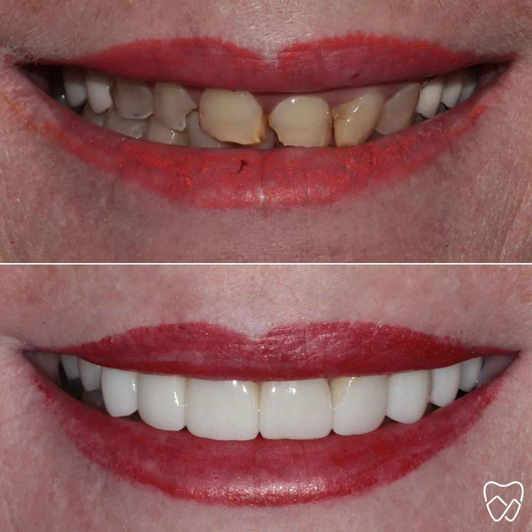 Before and after same-day cerec crown at Wildomar Smiles Dentistry