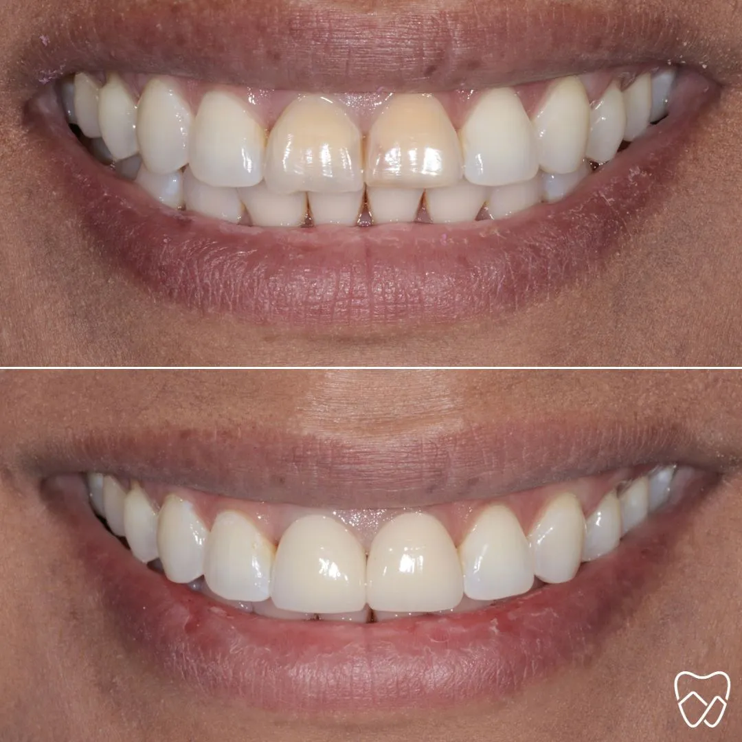 Before and after dental crowns at Wildomar Smiles Dentistry