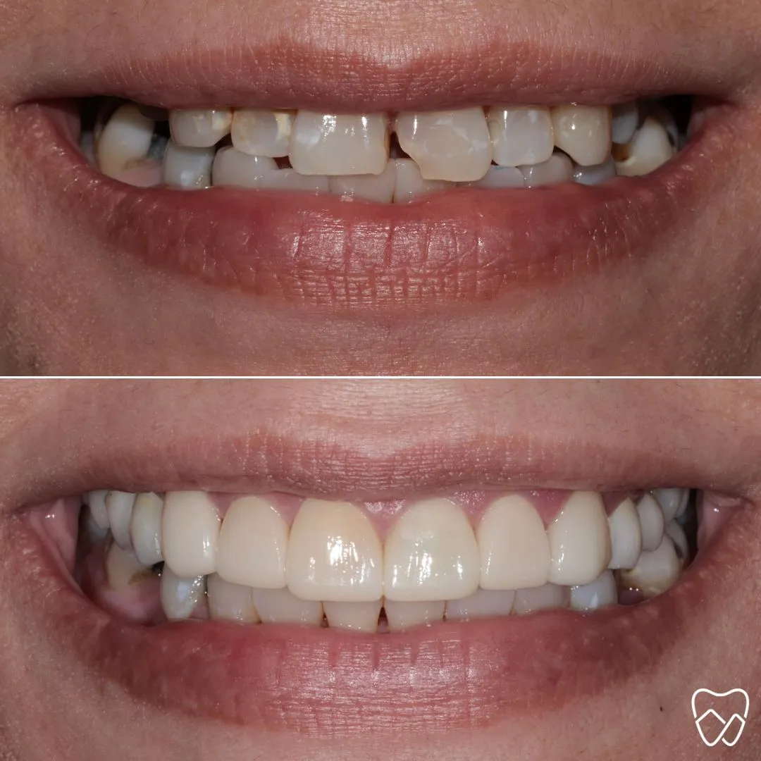 Before and after crowns, front teeth at Wildomar Smiles Dentistry