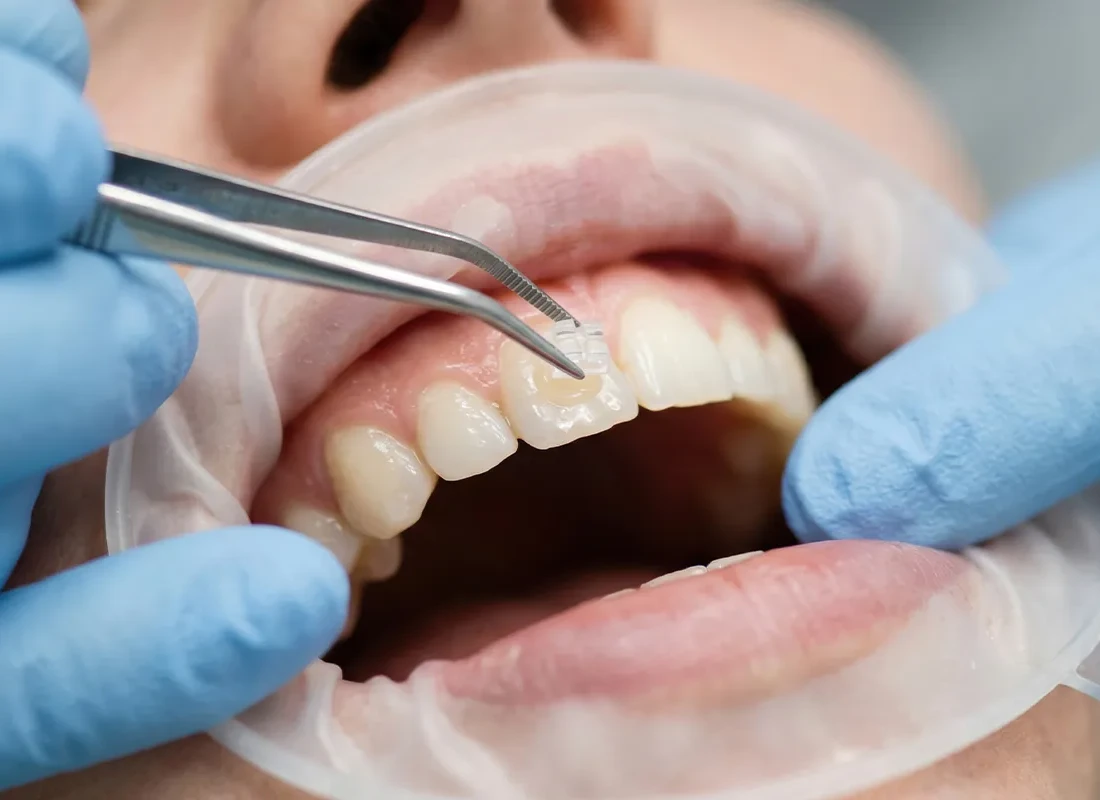 Dental Bonding at Wildomar Smiles Dentistry in Wildomar, CA