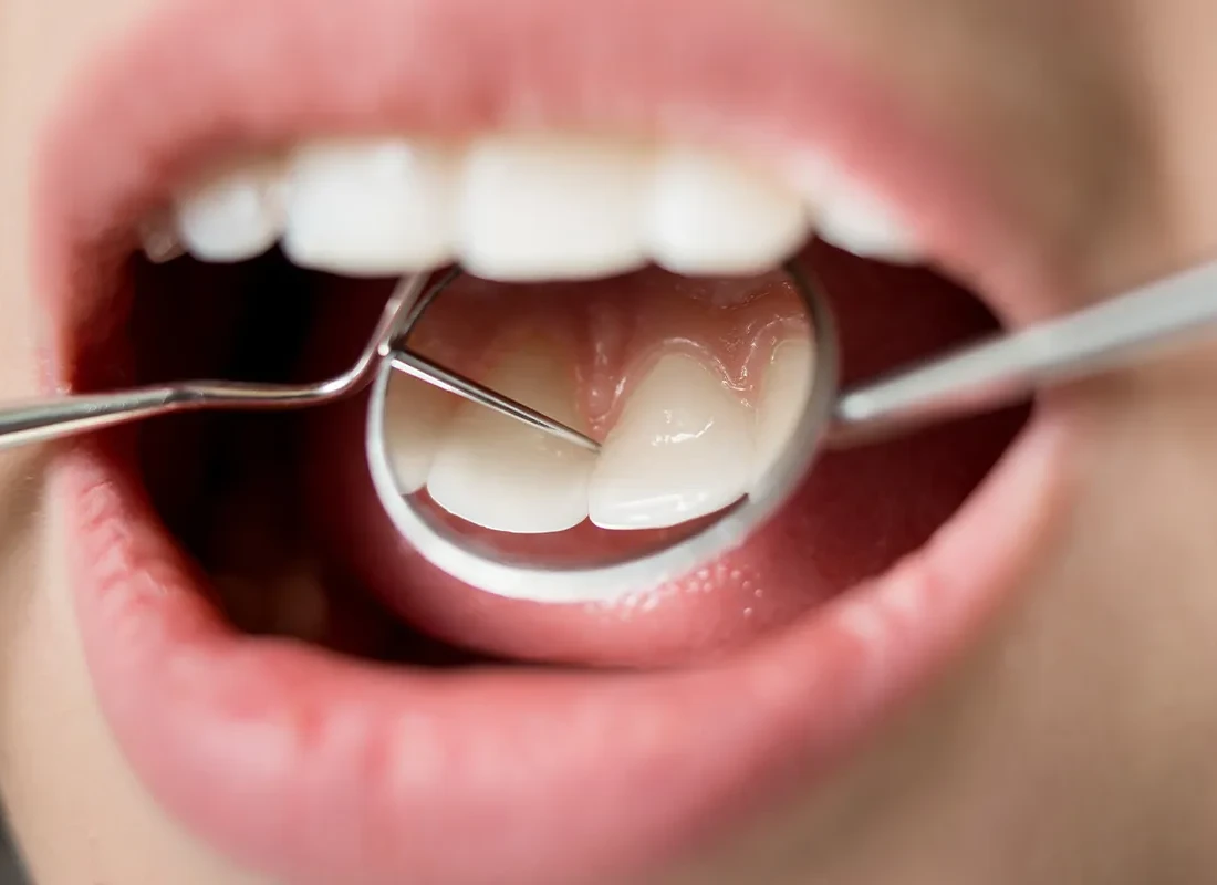 Teeth Cleaning at Wildomar Smiles Dentistry in Wildomar, CA