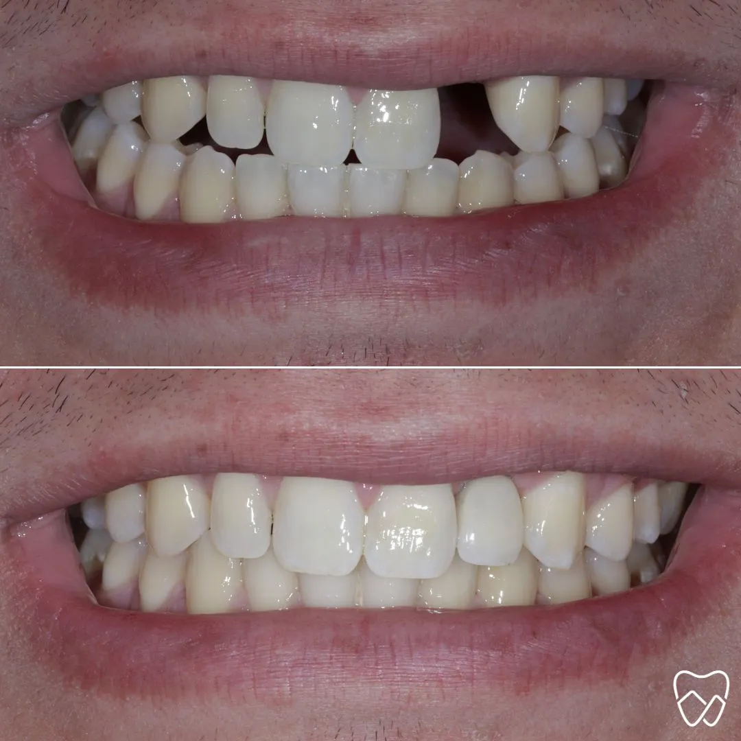 Dental Implants at Wildomar Smiles Dentistry
