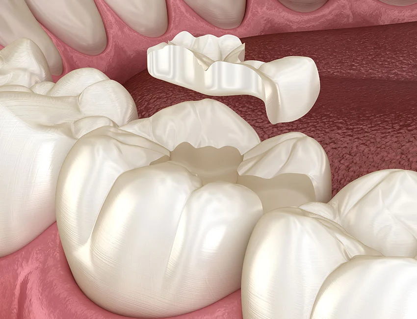 Restorative Dentistry at Wildomar Smiles Dentistry