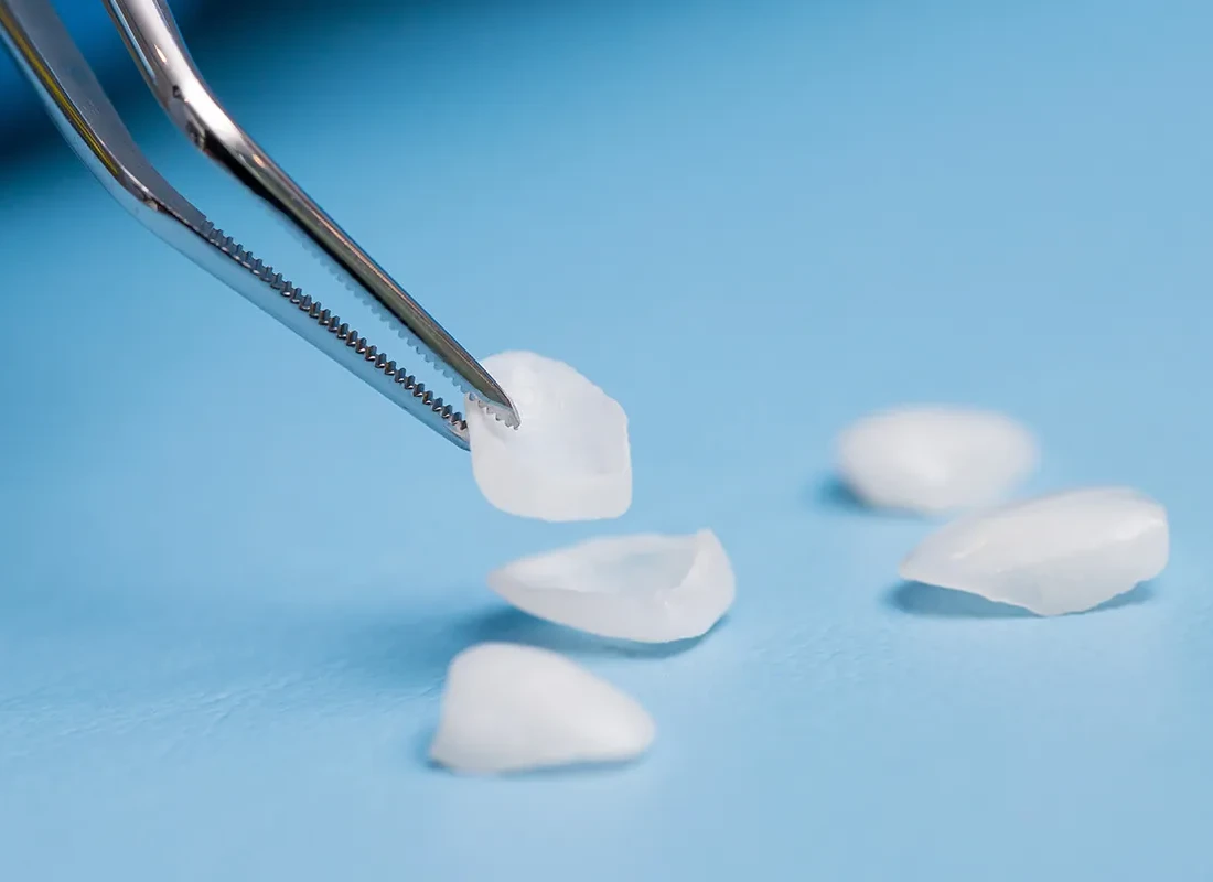 Porcelain Veneers at Wildomar Smiles Dentistry