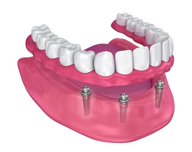A denture snapped onto three dental implants