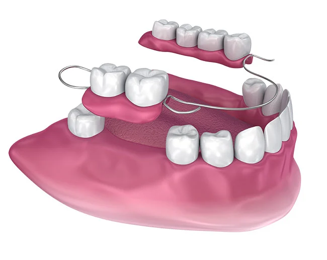 A partial denture clipped around the remaining teeth