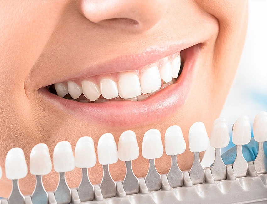 Wildomar Teeth Whitening: The Perfect New Year's Glow-Up — Wildomar Smiles Dentistry