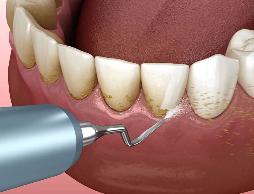 Achieving A Radiant Smile : Tips for National Dental Hygiene Month — Wildomar Smiles Dentistry