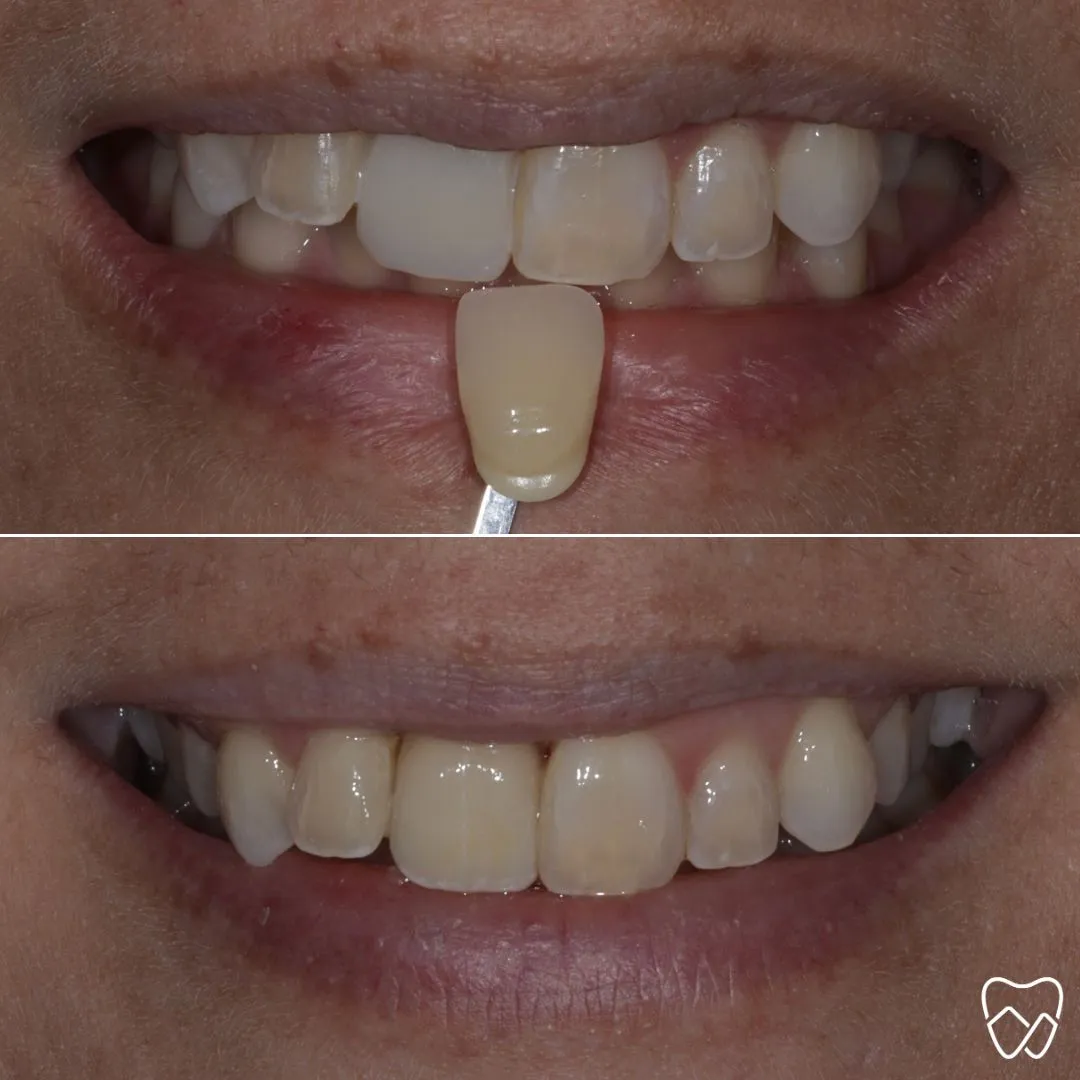 Before and after porcelain veneers at Wildomar Smiles Dentistry